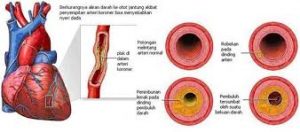 aterosklerosis