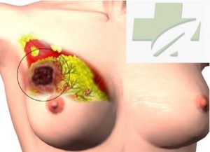 Akibat-Dari-Tumor-Payudara