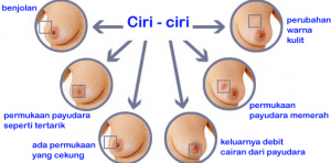 Ciri-Kanker-Payudara
