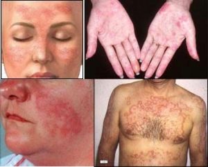 Lupus disease-definition-causes-symptoms