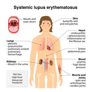 lupus-symptoms